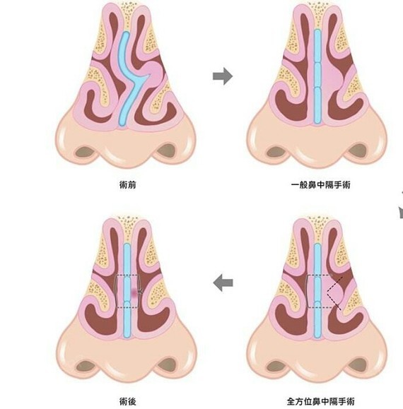 切口:左鼻前庭皮_圈子-新氧美容整形