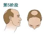 第5级:头顶部脱发面积继续扩大,前额和头顶部脱发区域被很窄的