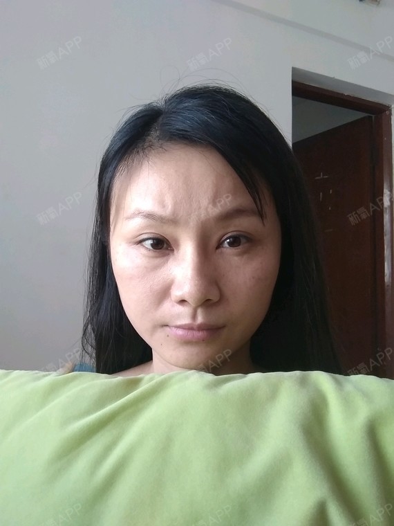 嘴角两边不知道是不是属于木偶纹,不笑的时_圈子-新氧