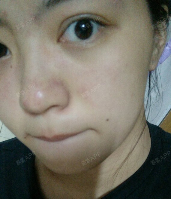 于去年暑假在上海九院做了双眼皮手术,但是感