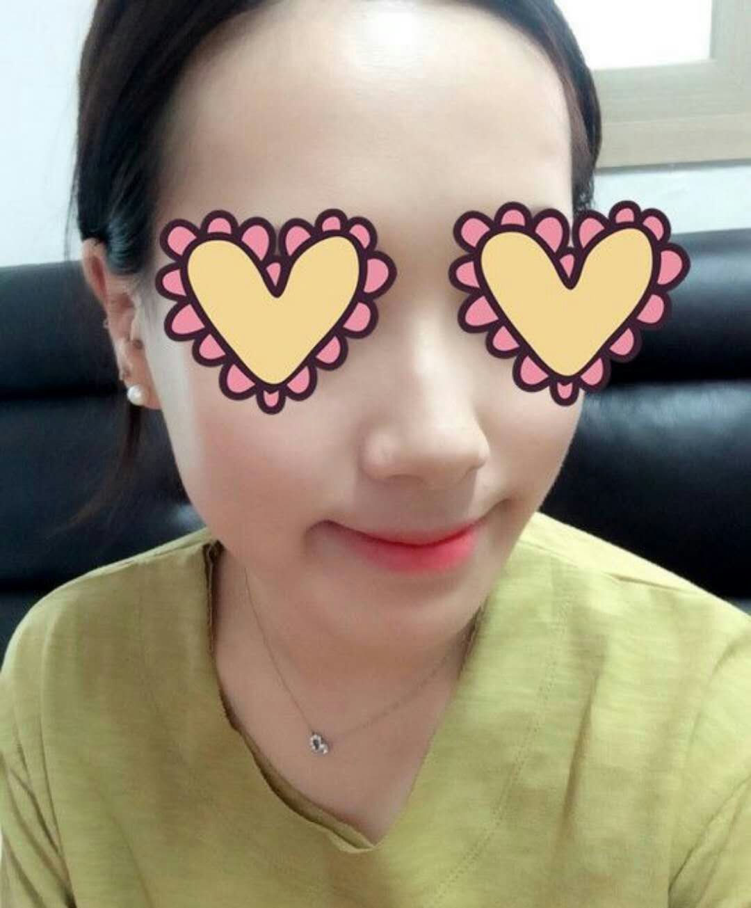 郑州元素美学整形酒窝成形术怎么样_恢复过程_效果如何_氧气ubo6a5b