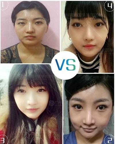 【广州曙光整形】:美女右侧上睑轻微下垂,掀开美女导致内衣图片