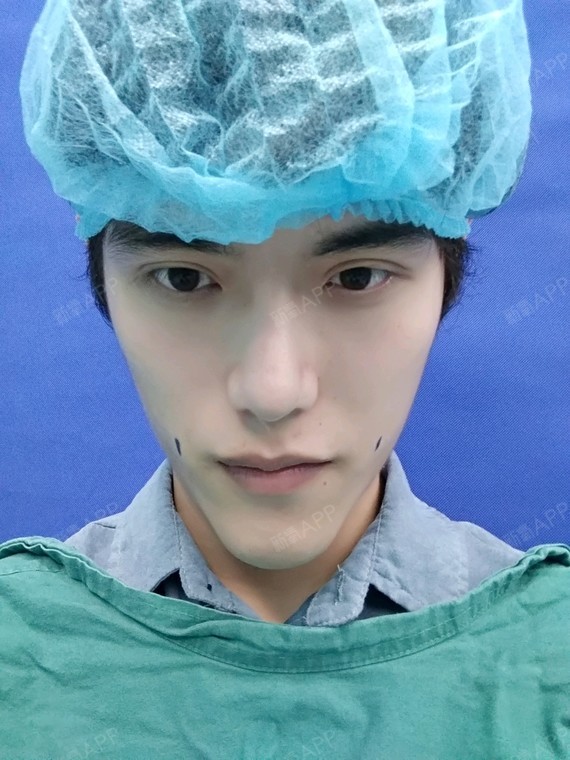 酒窝成形术