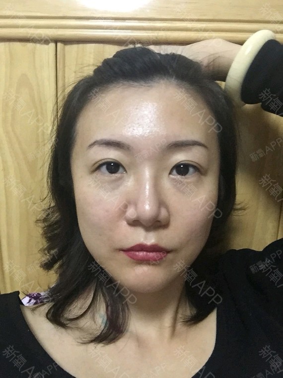 激光去眼袋