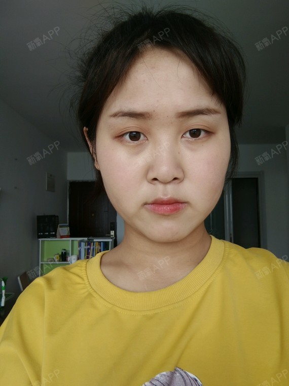 最近在考虑面部吸脂,感觉面部臃肿,像满月脸,一点都不清秀,也不符合我