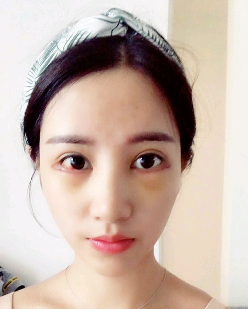 下眼下至术第5天