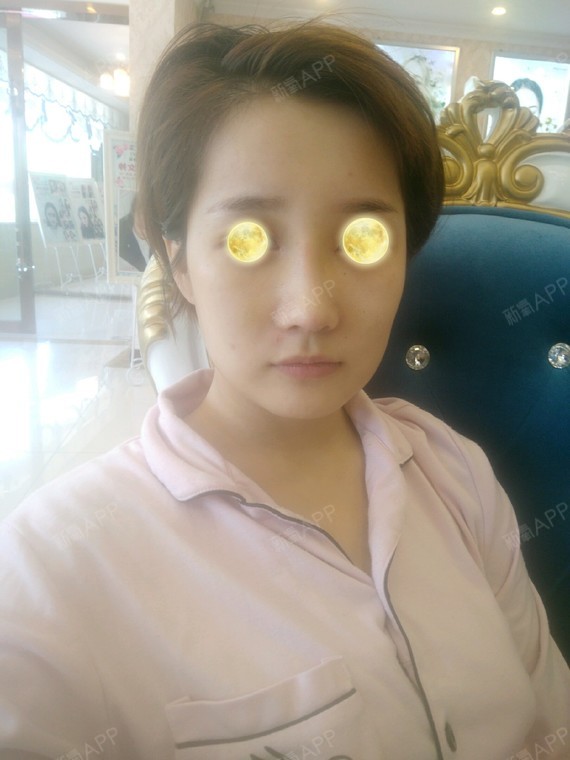 氧气2656871513479848开内眼角第10天美丽