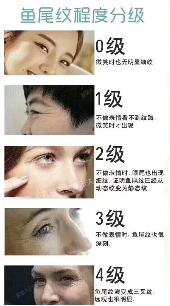 看下你的鱼尾纹是几级