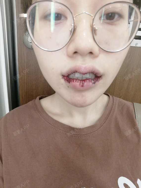 m唇手术