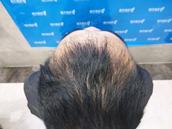 昆明雍禾植发进廷种植发际线第93天美丽日记