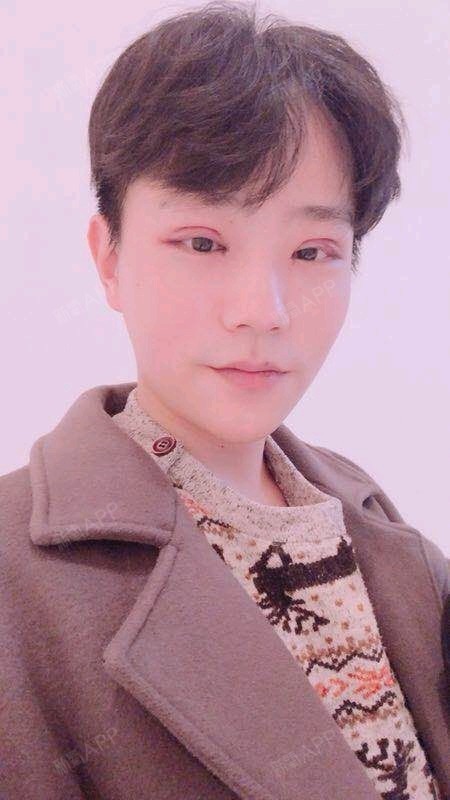 陈一成111开内眼角第1天美丽日记-新氧美容整