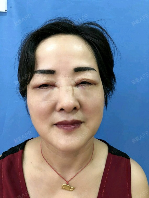 外切去眼袋