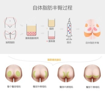 自体脂肪丰臀流程是怎样的?乳房、腰部及臀是