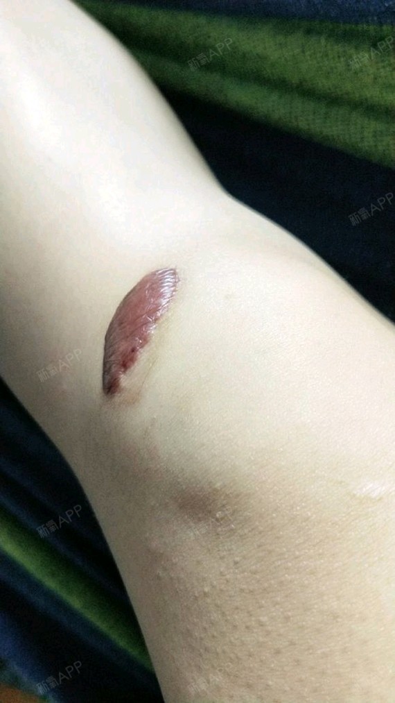 花中梦想注射祛疤第3天美丽日记