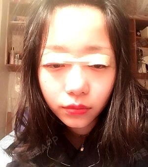 白人问号切开双眼皮第3天美丽日记-新氧美容整