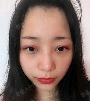 白人问号切开双眼皮第3天美丽日记-新氧美容整