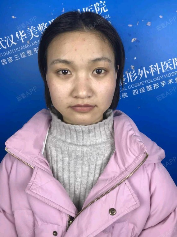 要做两个手术,突出术前的女生,颧骨看看轮廓暧昧情况很图片