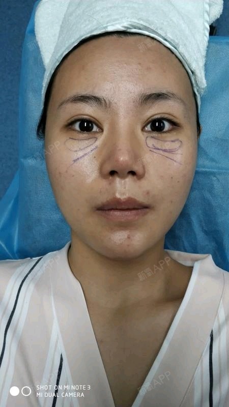 琪琪萌喵喵激光去黑眼圈第0天美丽日记-新氧美容整形