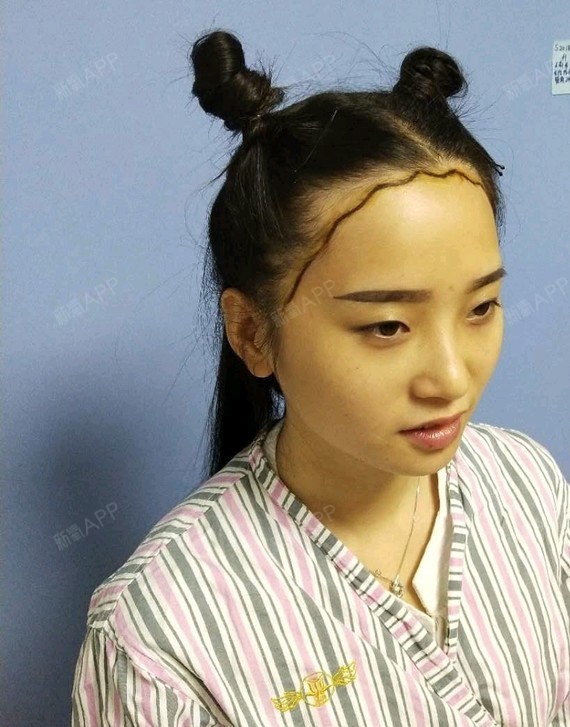 发际线调整案例#小姑娘的五官很漂亮,就是烦忧发际线,不敢露
