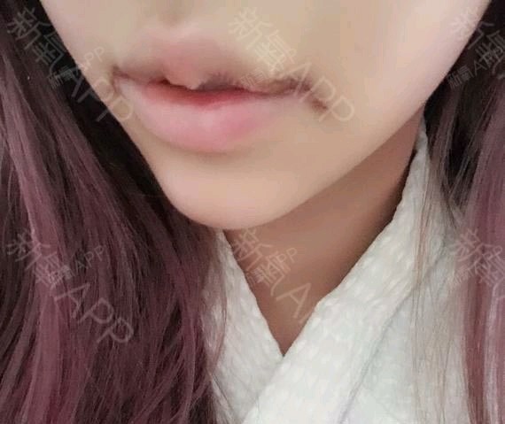 m唇手术