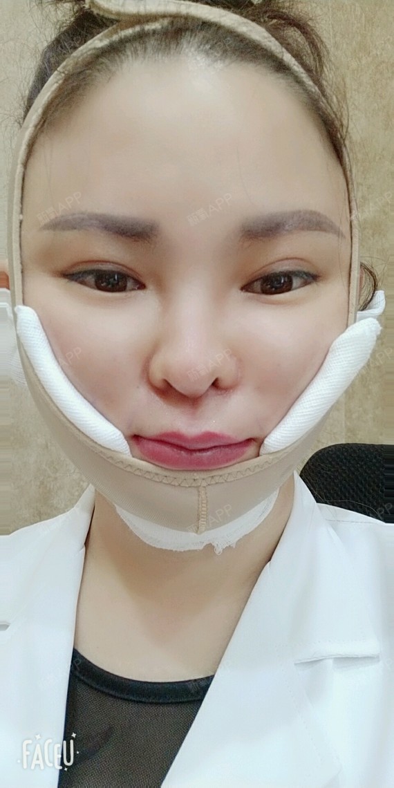 光纤溶脂瘦脸
