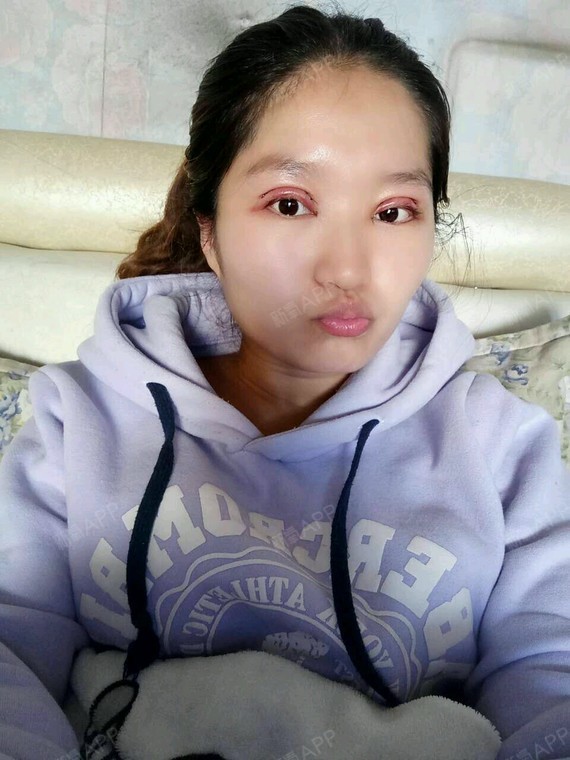 上睑提肌