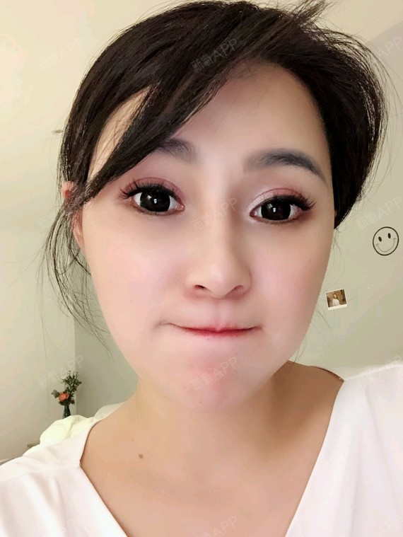 开外眼角