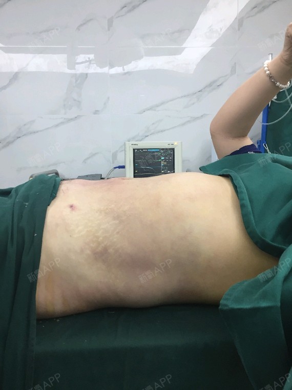 即可动身吸脂瘦腰腹第1天美丽日记