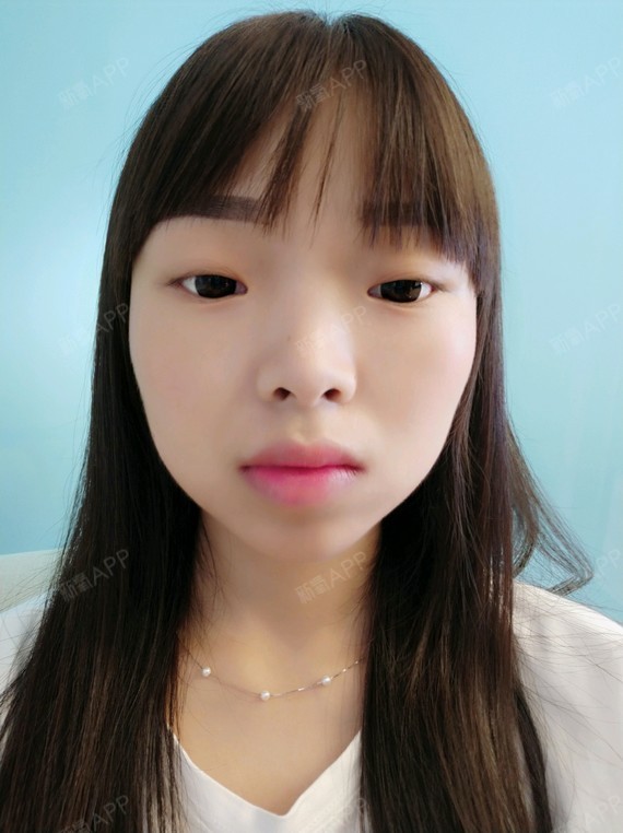 之前打过一针瘦脸,今天是溶脂瘦脸一起做的,过段时间效果出来了发照片