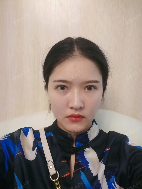 7月5号做了下颌缘提升,打了保妥适肉毒素下颌缘提升