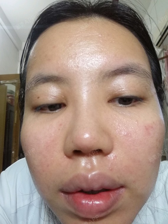 请问激光祛痘印后多久能洗脸?用的是赛诺龙的