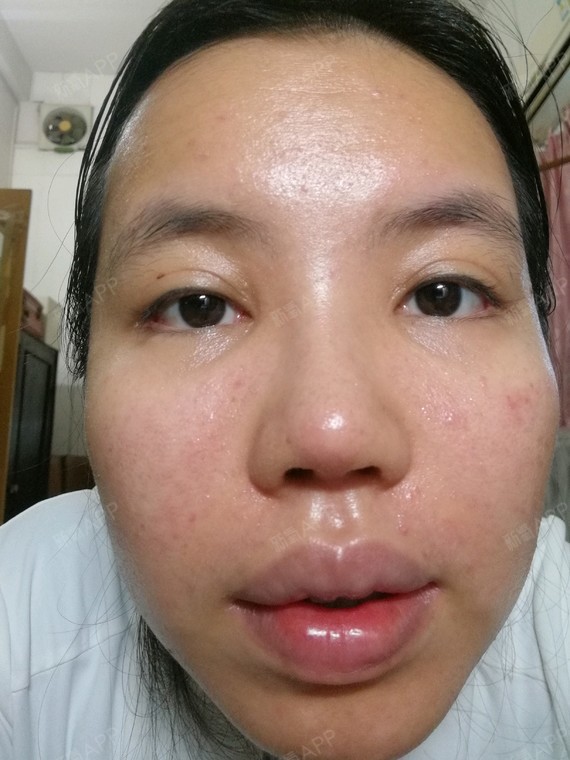 请问激光祛痘印后多久能洗脸?用的是赛诺龙的