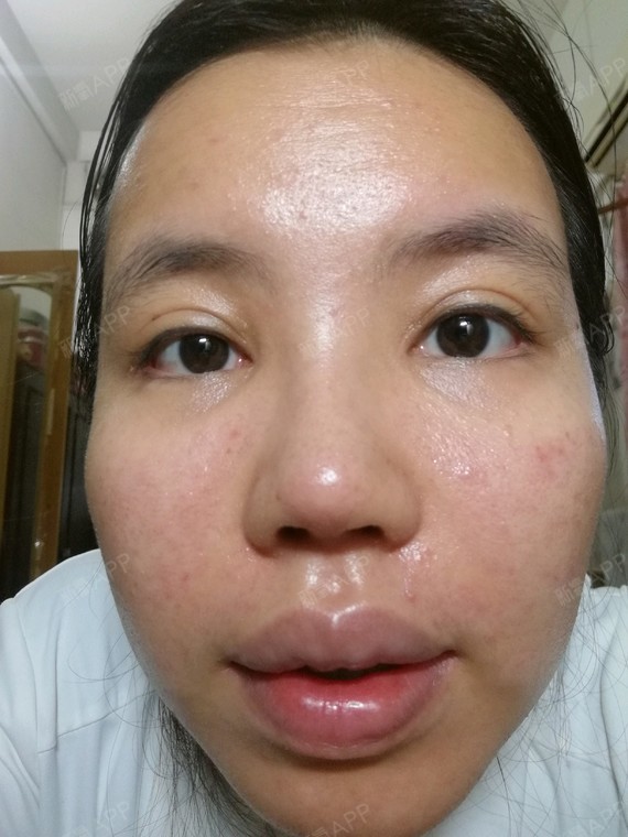 请问激光祛痘印后多久能洗脸?用的是赛诺龙的