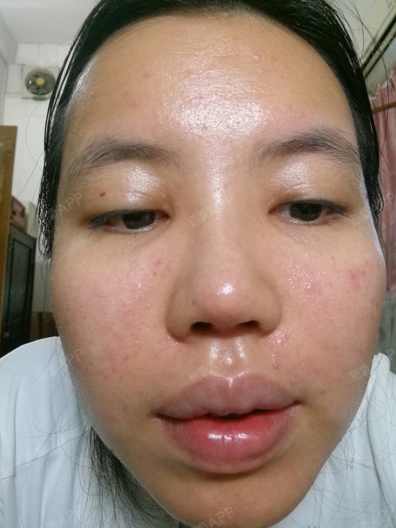 请问激光祛痘印后多久能洗脸?用的是赛诺龙的