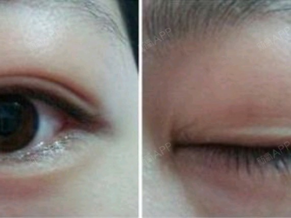 可以的.首先,肿泡眼又叫肉泡眼