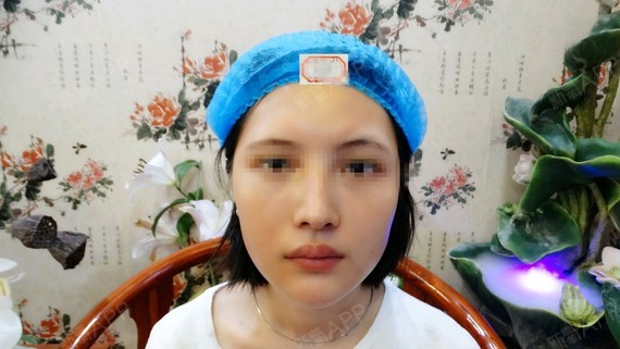 广州肤康皮肤科医院红蓝光祛痘第63天美丽日