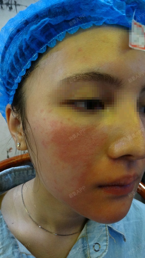 广州肤康皮肤科医院红蓝光祛痘第0天美丽日记