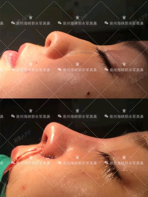 注射骨粉2年,鼻孔大小不一,给予自体肋软骨膨体综合隆鼻修复