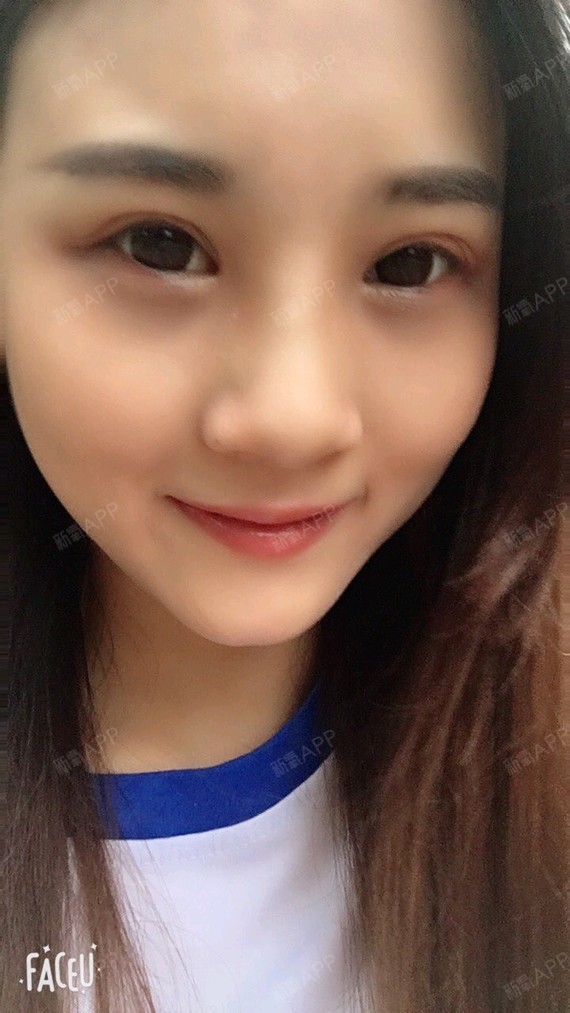 安安ANan宽鼻矫正第15天美丽日记-新氧美容整