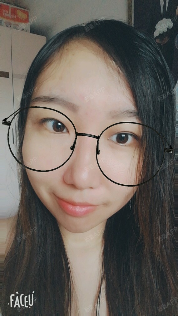 季少爷丶爱酱玻尿酸丰太阳穴第3天美丽日记-新