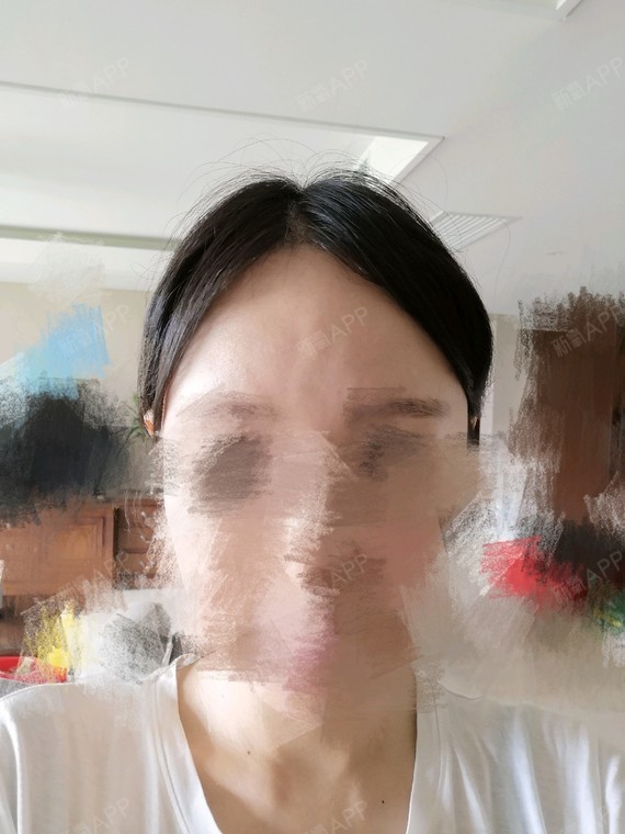 想说我在新氧云诊所做的热玛吉加超声提升效果很差,额头直接凹凸不平