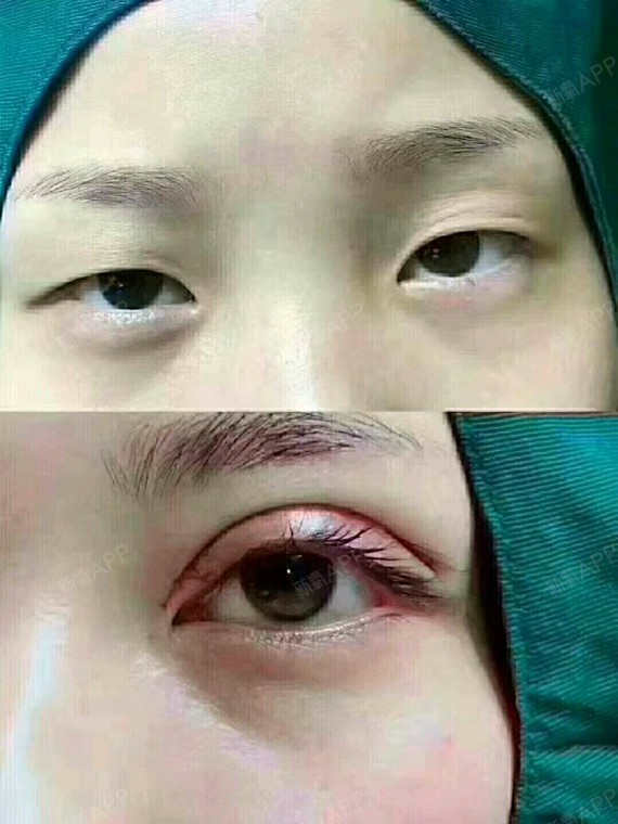 小眼综合:双眼皮内眼角去皮去脂翘睫提肌