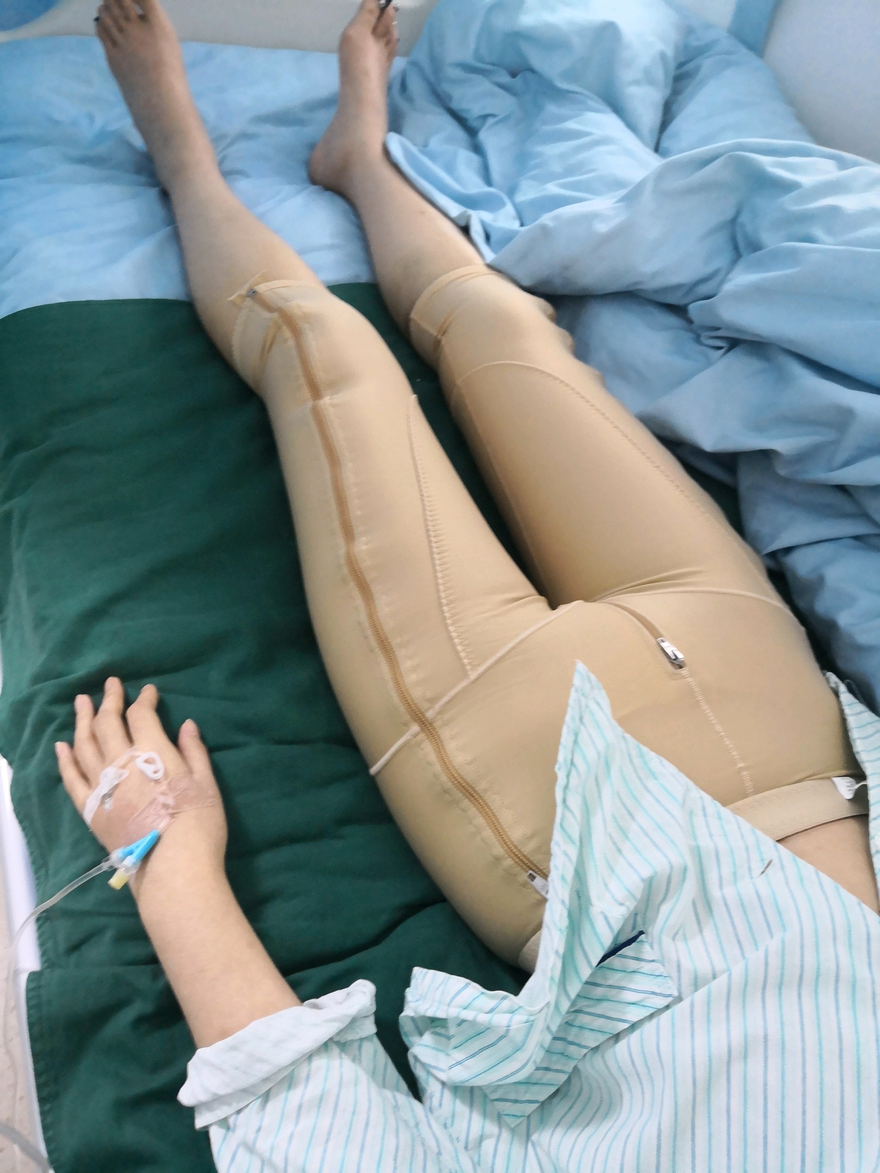 吸脂瘦大腿第3天