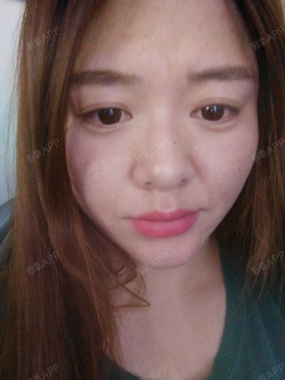 皮肤怎么才能好皮肤暗沉粗糙毛孔粗大,下垂,检