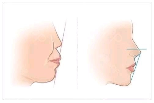 鼻整形能解决嘴凸问题吗?依据具体嘴凸情况