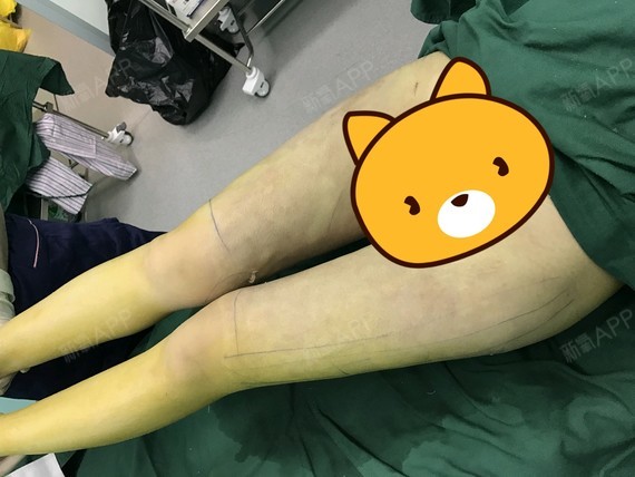 我在烦恼什么吸脂瘦大腿第0天美丽日记-新氧美