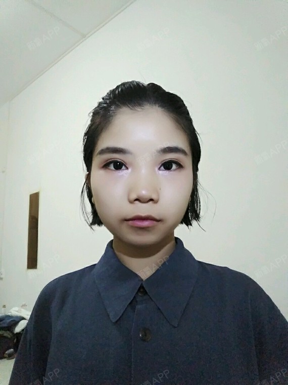 开内眼角好不好_效果图_花田君开内眼角术后第303天