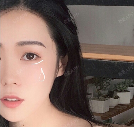 莲花一梦补牙第10天美丽日记-新氧美容整形