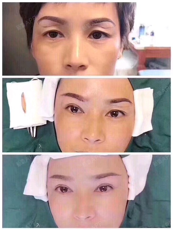 提眉,除皱,瘦脸,效果图.