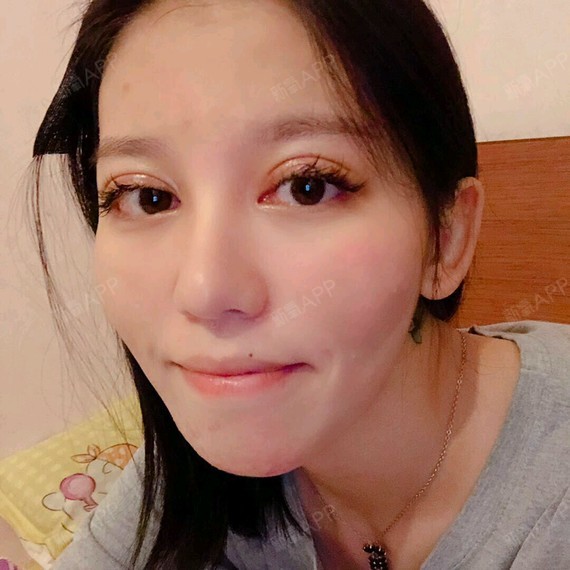 破音文眼部修复第12天美丽日记-新氧美容整形